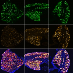 After an injury, neurons undergo genetic changes that are initiated by DLK and lead to pain and nerve damage. Over time (left to right), certain genes become more active.